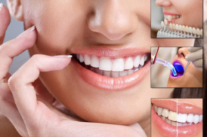 Unlocking the Secrets of Teeth Whitening: A Complete Guide to a Dazzling Smile
